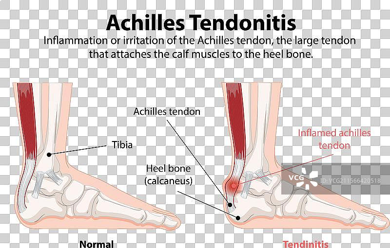 正常和发炎的跟腱比较图片素材