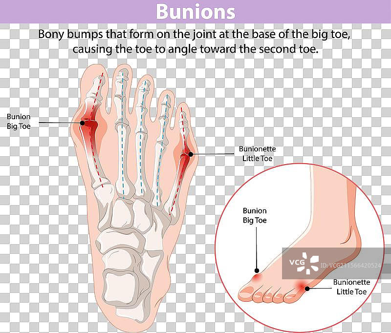 大脚趾和小脚趾的拇外翻图片素材