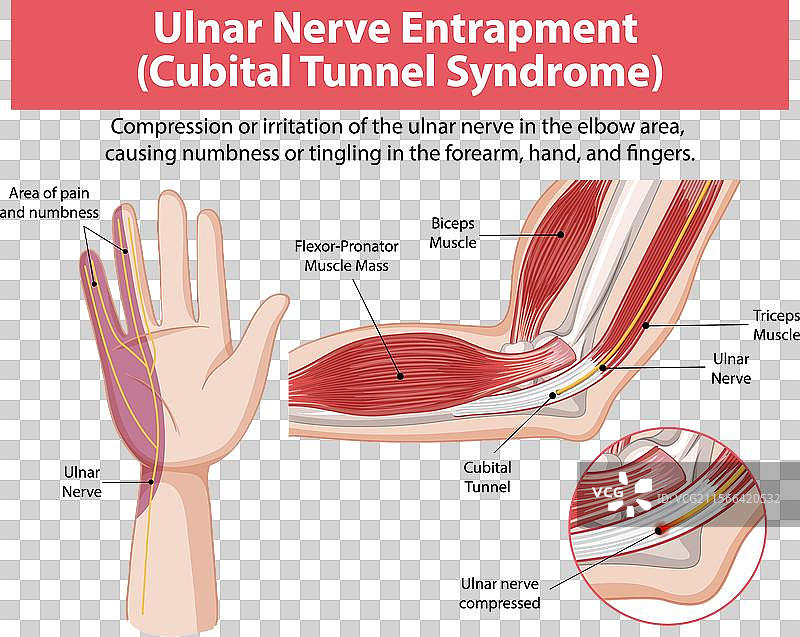 肘管综合症的详细图解图片素材