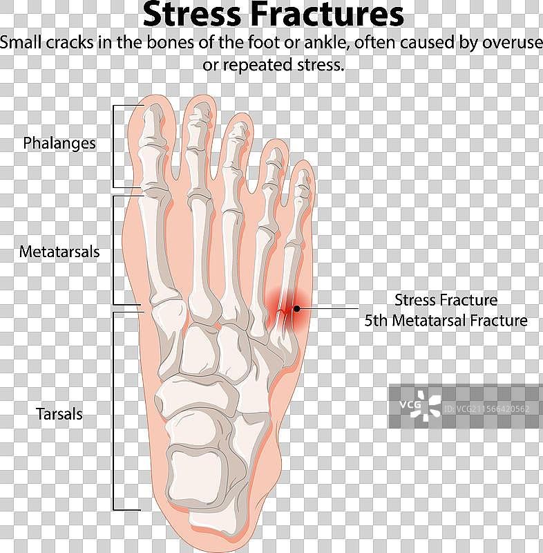 脚骨应力性骨折图片素材