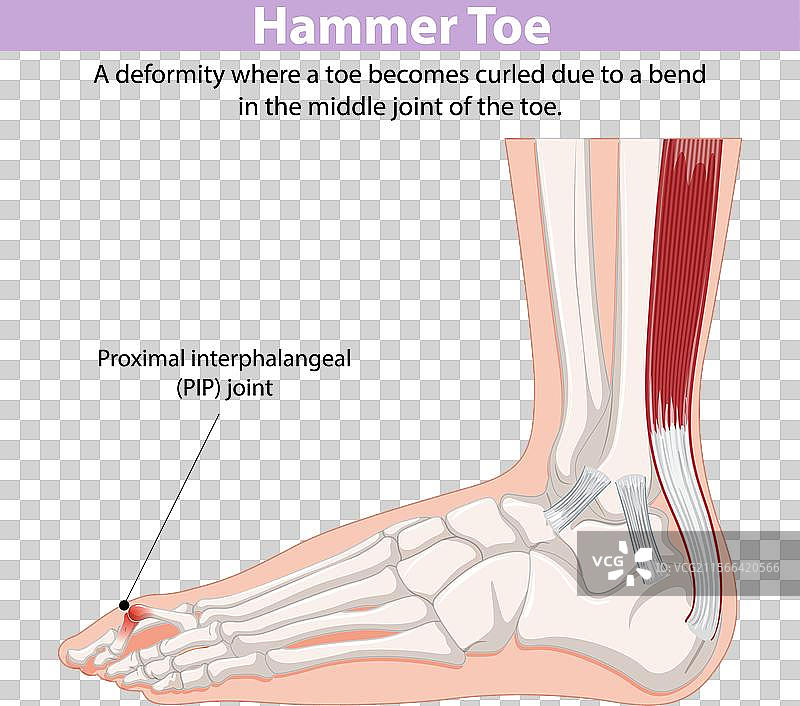 显示锤状趾和PIP关节的图解图片素材