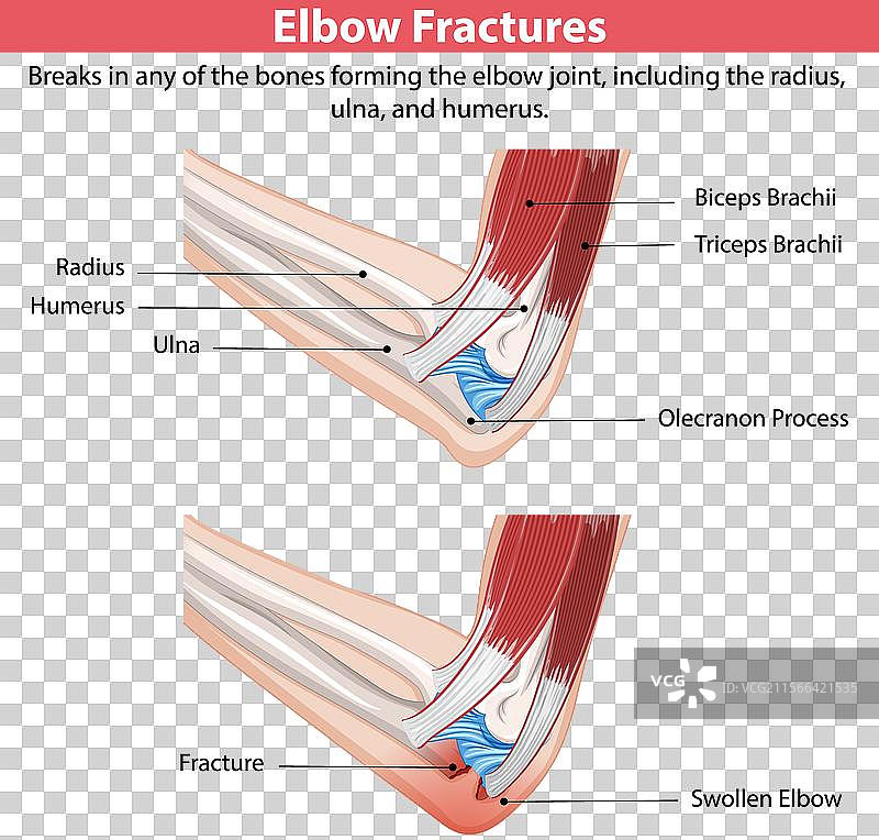 肘部骨折的详细图解图片素材