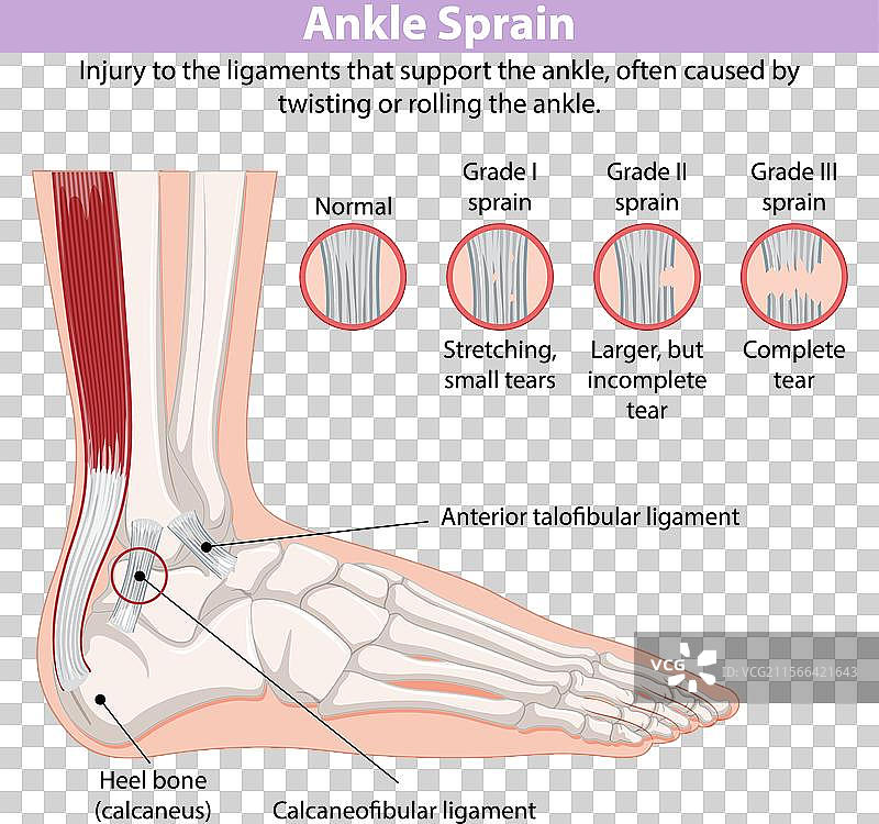 踝关节扭伤类型的详细图解图片素材