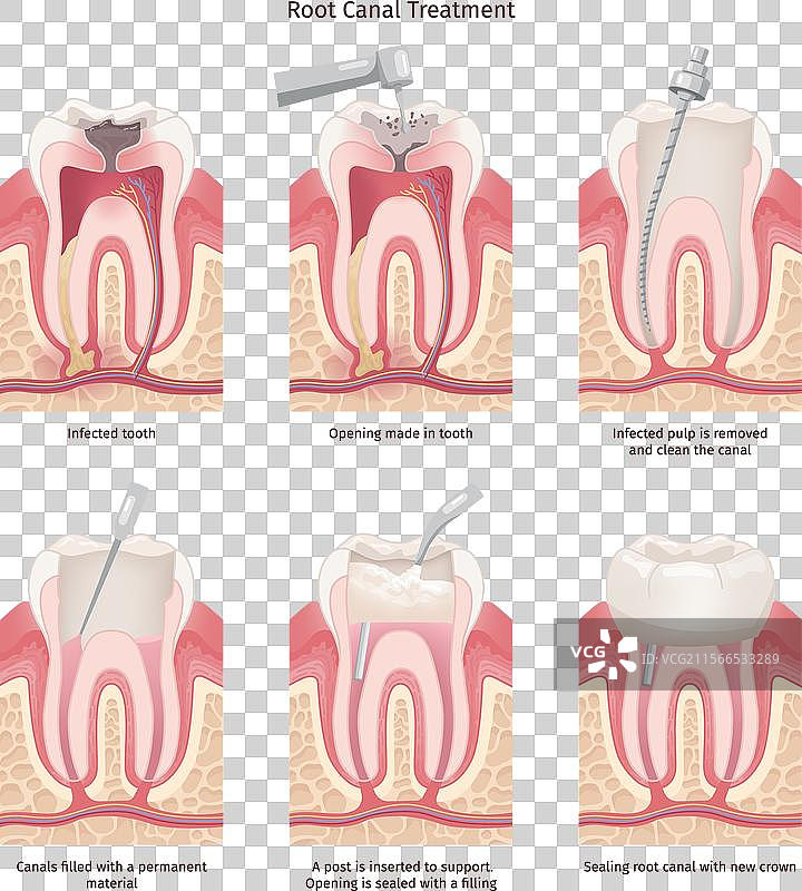 根管治疗牙齿根管填充图片素材