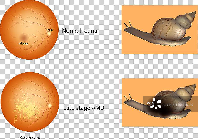 晚期年龄相关性黄斑变性（AMD）图片素材