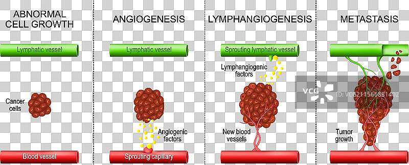 癌症肿瘤发展中的血管生成与图片素材