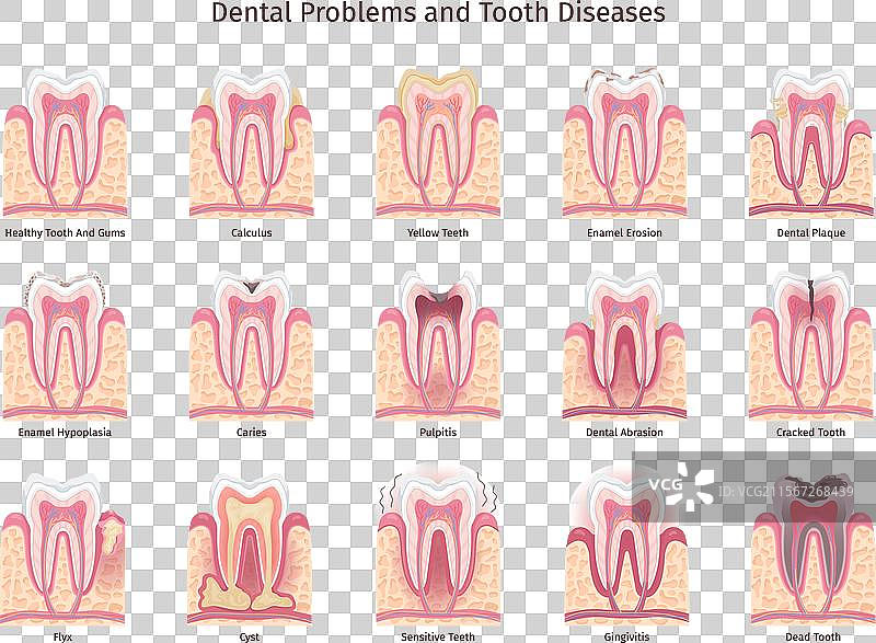 牙齿问题信息图：人类牙齿蛀牙图片素材
