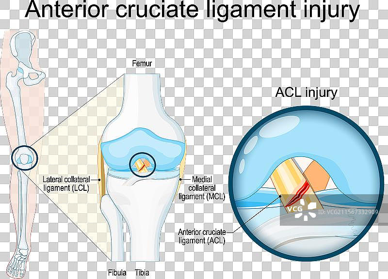 前交叉韧带损伤特写图片素材