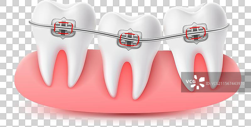 给牙齿安装牙套以矫正歪牙图片素材
