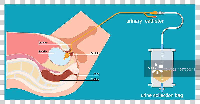 男性体内的尿管与尿袋图片素材
