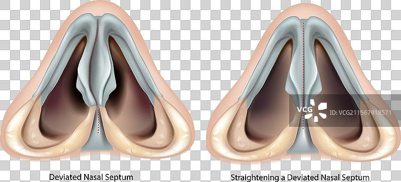 偏曲的鼻中隔和矫正偏曲的鼻中隔图片素材