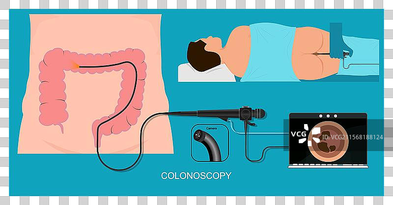 结肠镜检查是一种用于寻找变化的检查。图片素材
