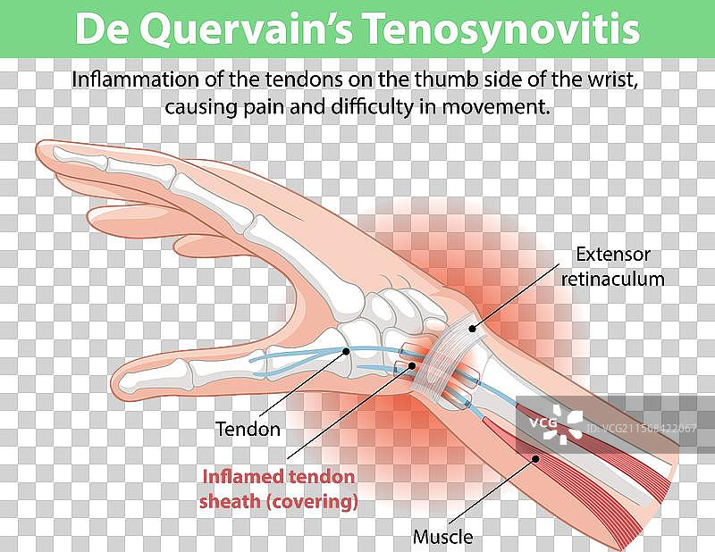 拇指肌腱炎引起的手腕疼痛图片素材