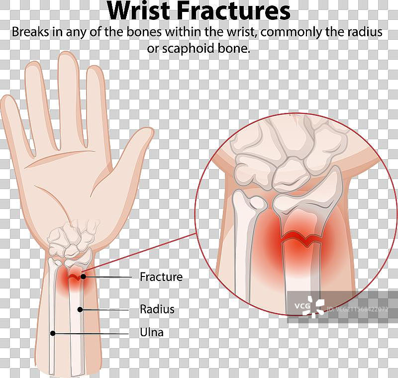 腕部骨折及受影响的骨骼图片素材