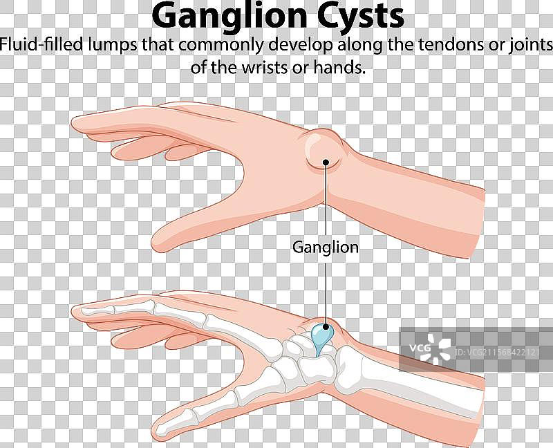 手腕和手上的神经节囊肿图片素材