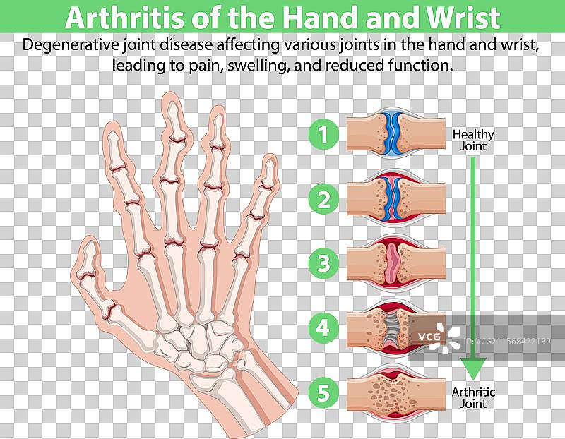 影响手部的退行性关节疾病图片素材