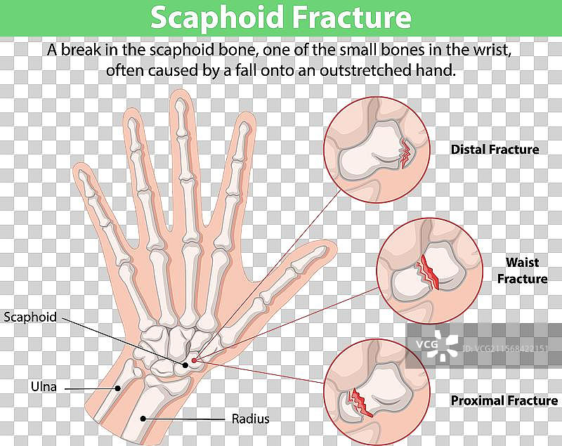 腕部舟骨骨折图片素材