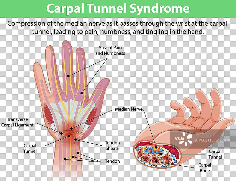 腕管综合症的详细图解图片素材