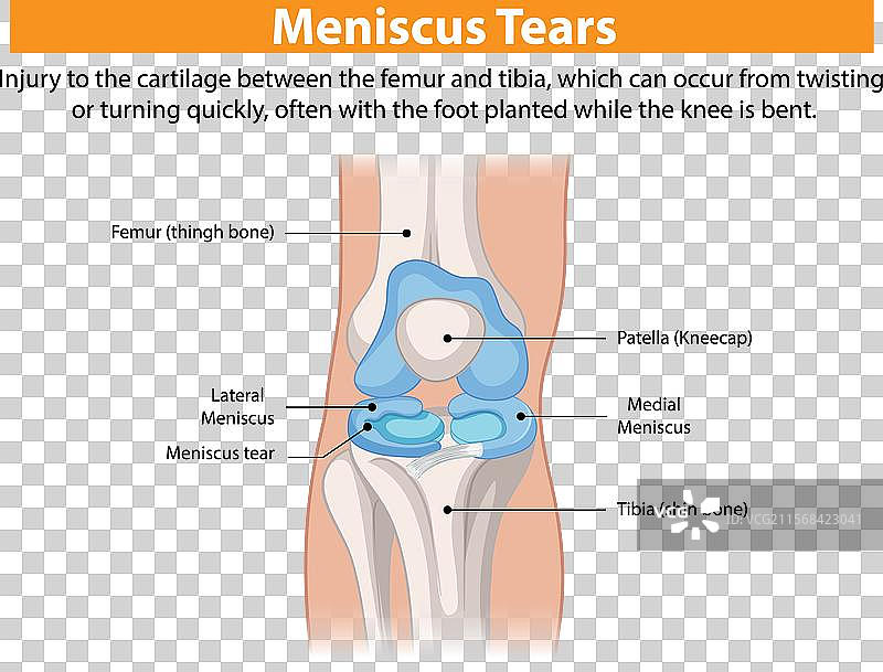 膝关节半月板撕裂解剖结构图片素材