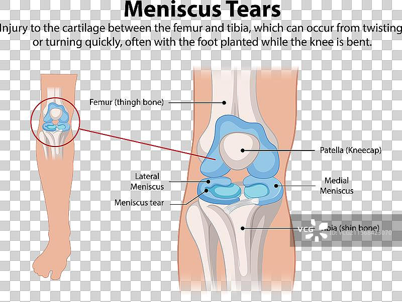 膝关节半月板撕裂解剖结构图片素材