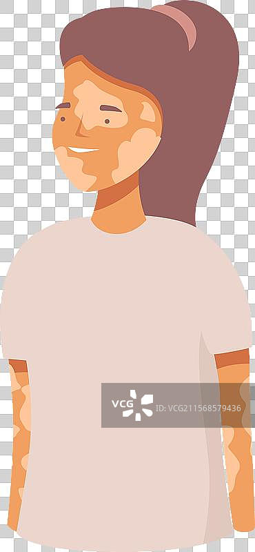 年轻女性带有白癜风，微笑并感到愉悦图片素材