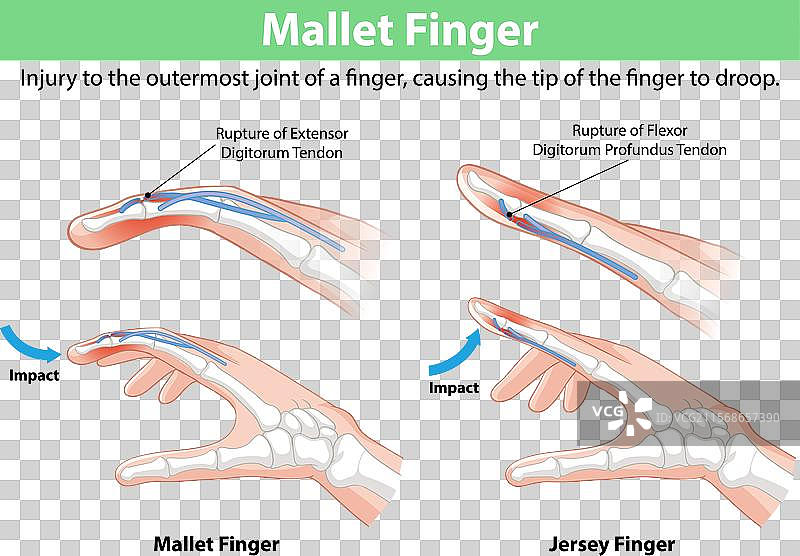 手指肌腱损伤及其影响图片素材