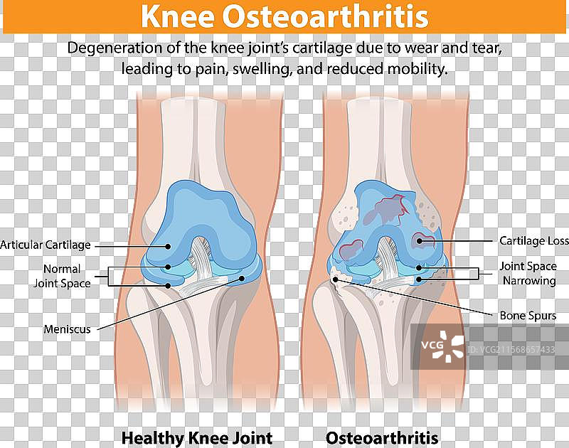 健康的膝关节与受骨关节炎影响的膝关节图片素材
