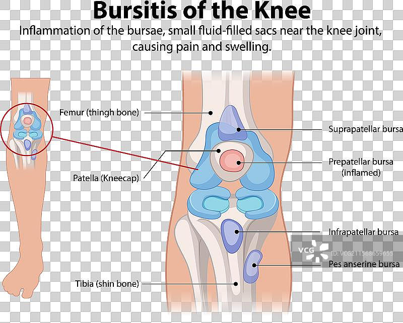 膝关节滑囊炎引起的疼痛和不适图片素材