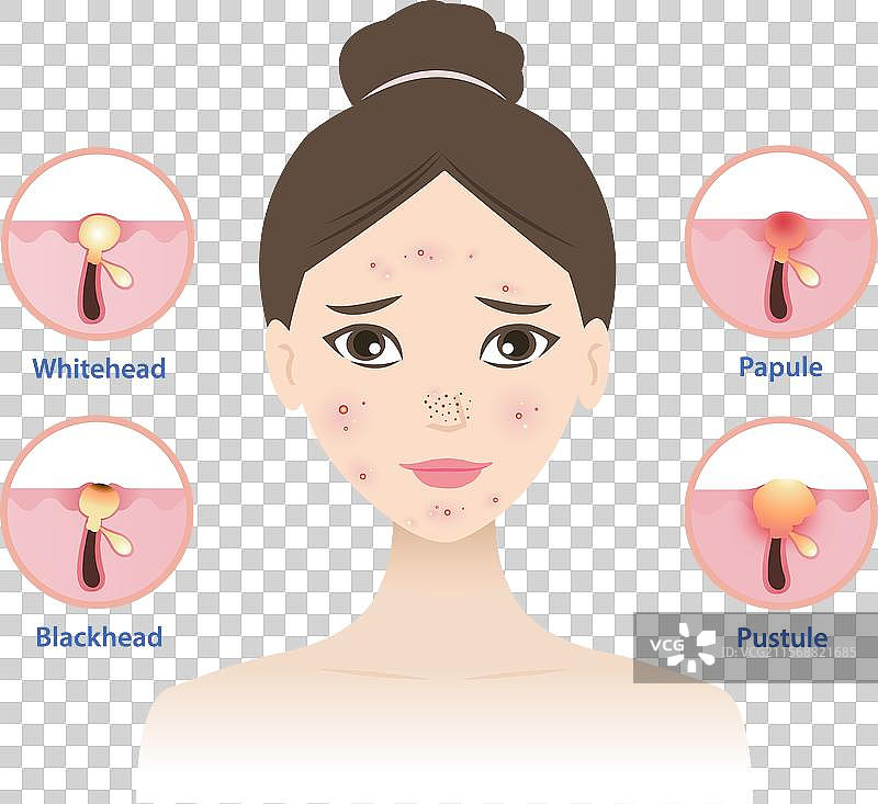 女性面部痤疮的类型图片素材
