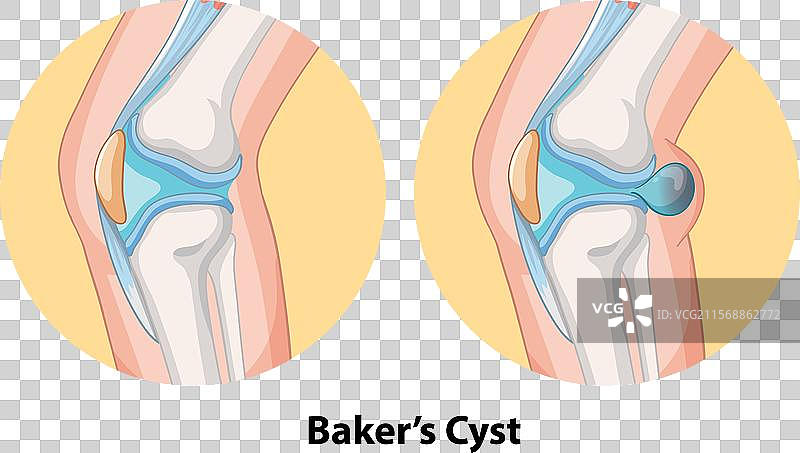 膝关节的贝克囊肿图片素材