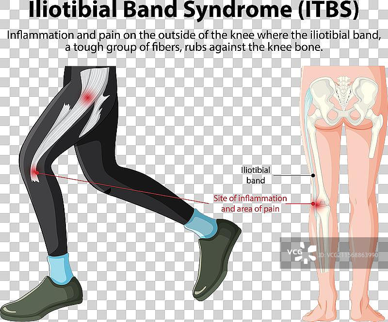 膝关节髂胫束综合症疼痛和炎症的表现图片素材