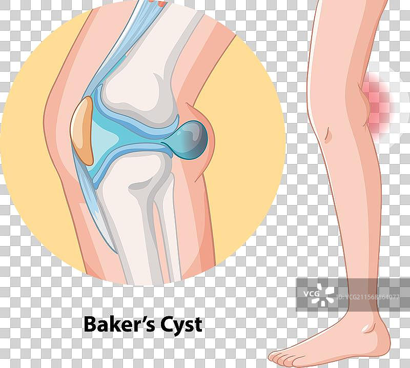 膝盖的贝克囊肿图片素材