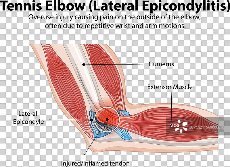 网球肘病症的详细图解图片素材