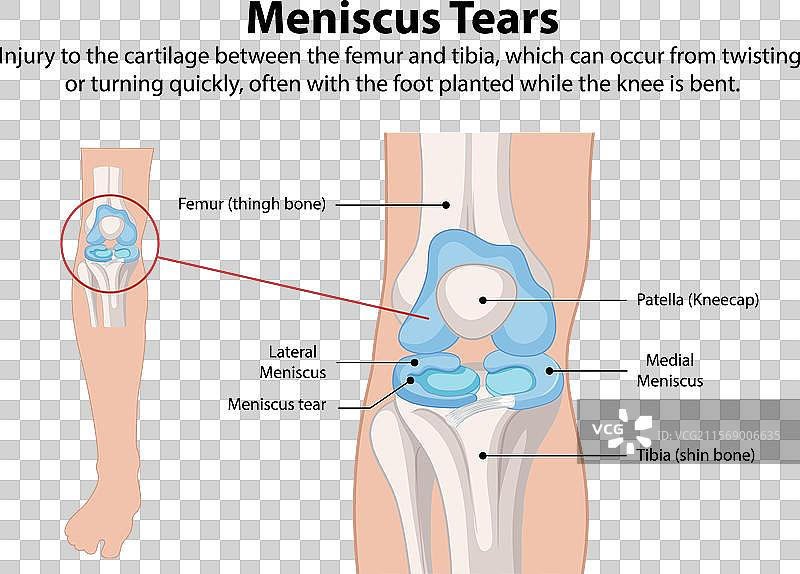 膝关节解剖与半月板撕裂图片素材