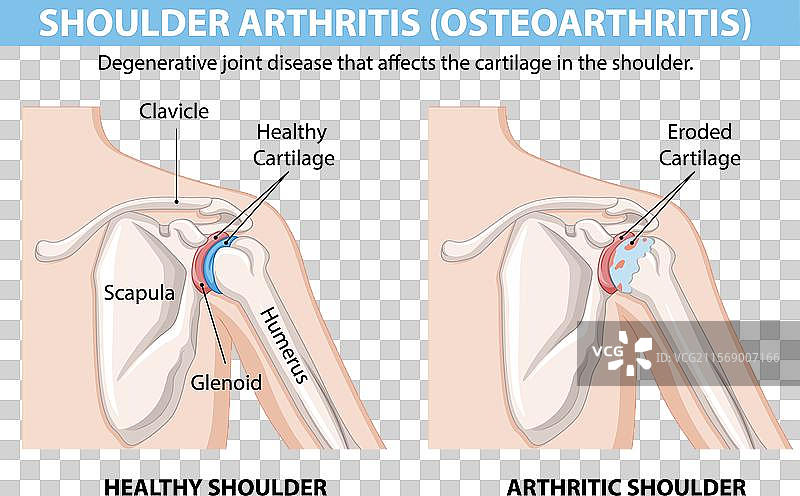 健康和关节炎肩关节图片素材