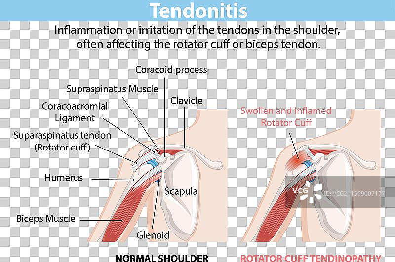 正常和发炎的肩部肌腱图片素材