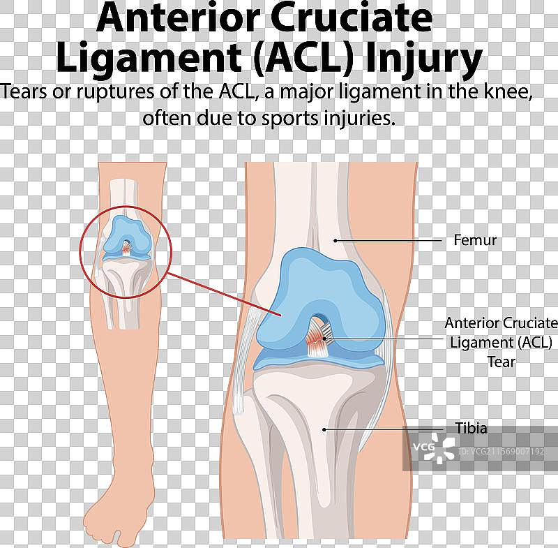 膝关节前交叉韧带撕裂图片素材