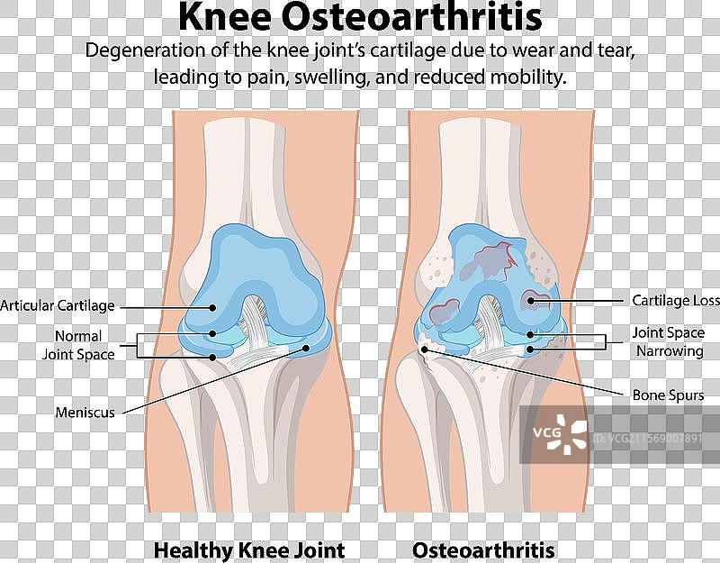 健康的膝关节与骨关节炎膝关节图片素材