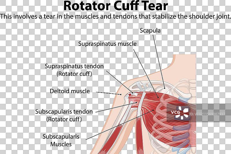 肩部旋转袖撕裂的详细解剖结构图片素材