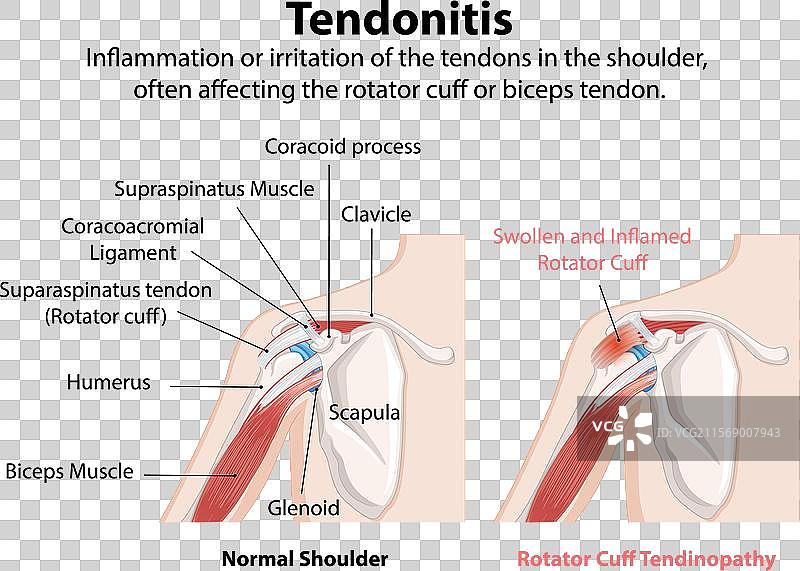 正常和发炎的肩部肌腱图片素材