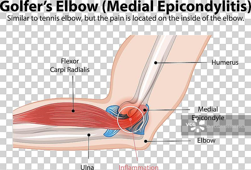肱骨内上髁炎的详细图解图片素材