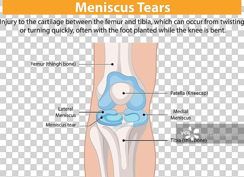膝关节半月板撕裂解剖结构图片素材