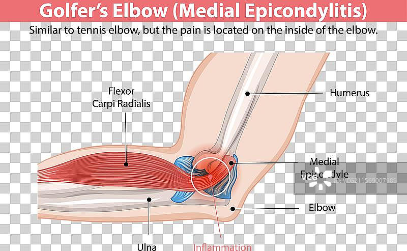 内侧上髁炎的详细图解图片素材