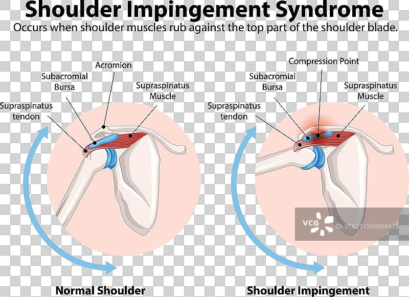 正常肩关节与肩部撞击的比较图片素材