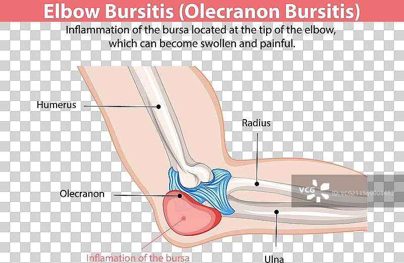 肘部滑囊炎图片素材