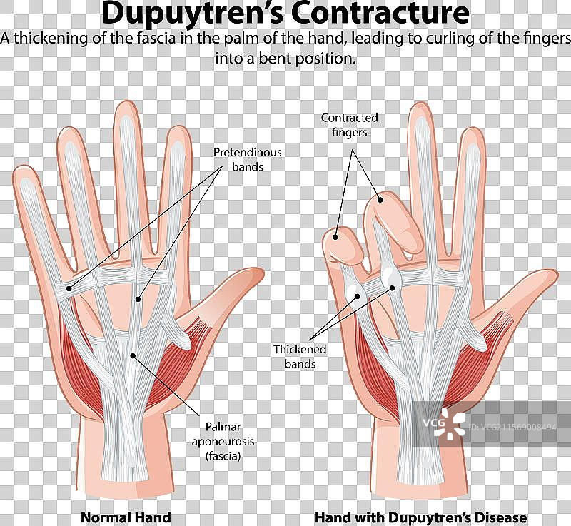 正常手与受影响手的对比图片素材