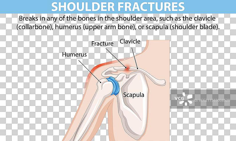 肩部骨骼及骨折位置示意图图片素材