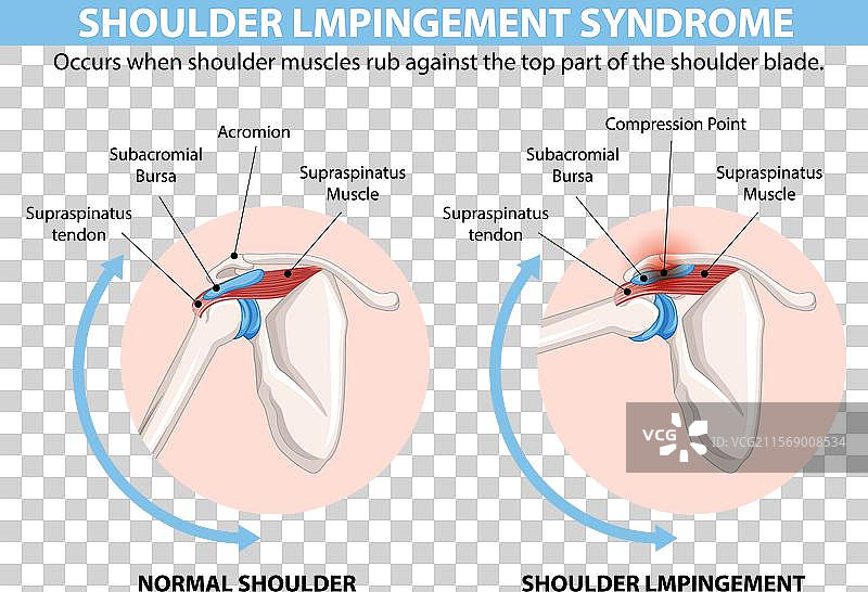 正常肩部解剖与受压肩部解剖的比较图片素材