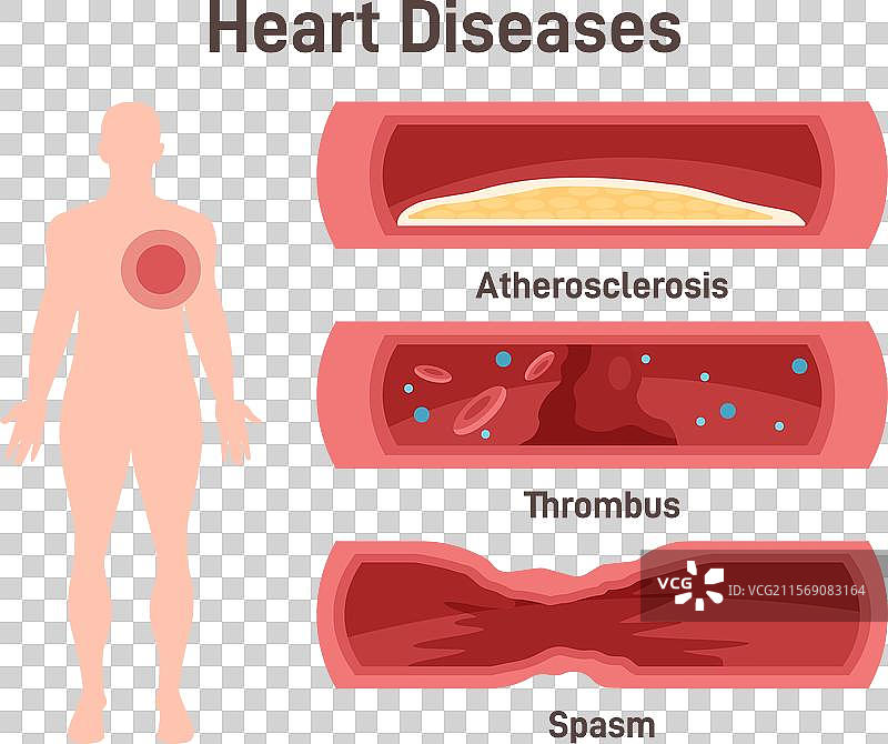 心脏病、动脉粥样硬化、血栓图片素材