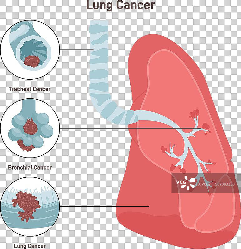 支气管癌病理恶性细胞图片素材